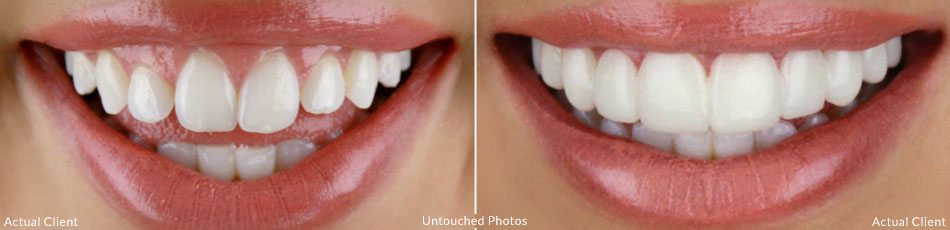 Actual Client of Brighter Image Lab wearing removable "BILVeneers" cosmetic dentistry