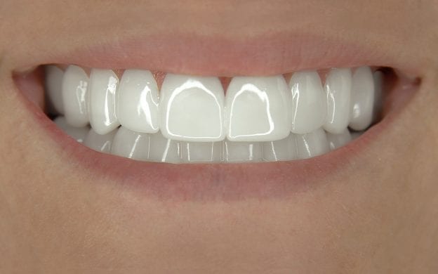 Incredibil™ Veneers gapped teeth client after