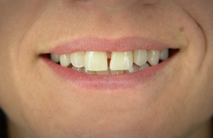 10x-white-heather-before-close-430x279_c