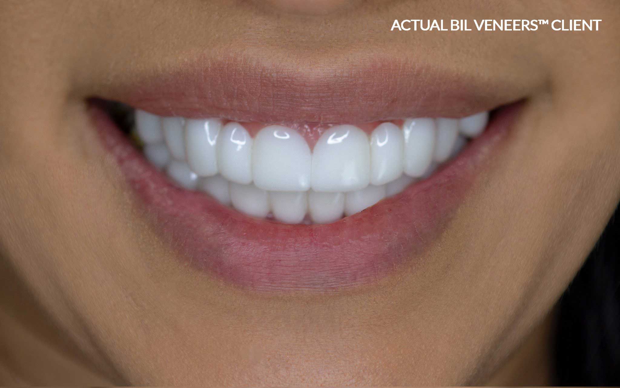 Bil Veneers Bil Veneers on our client Ana