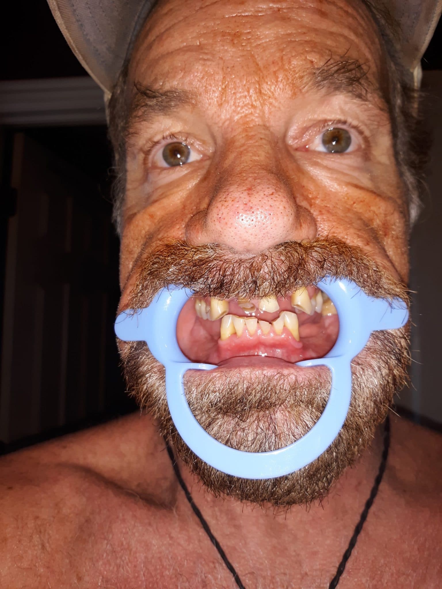 missing teeth