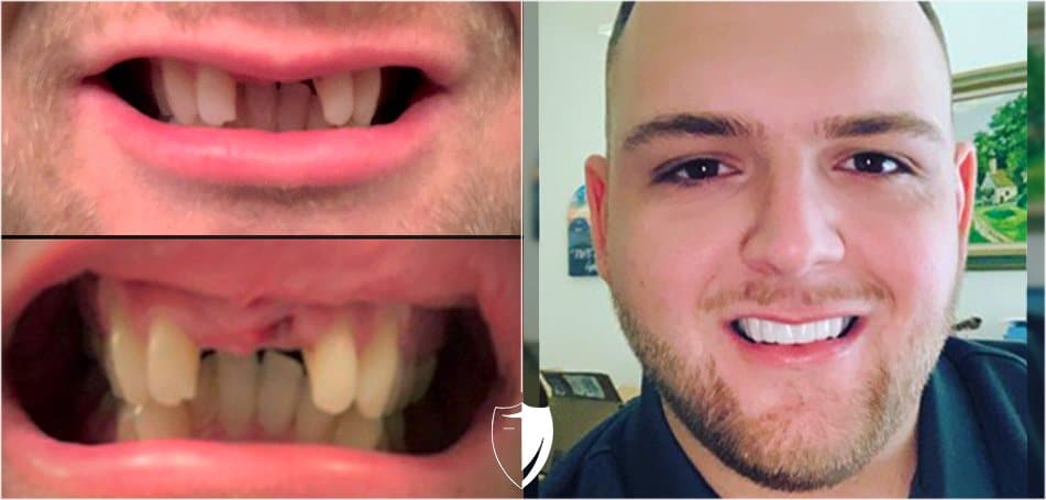 Stacy-Closeup.jpg We have your missing teeth covered - Bil Veneers by Brighter Image Lab