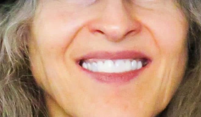 smile makeover smile makeover