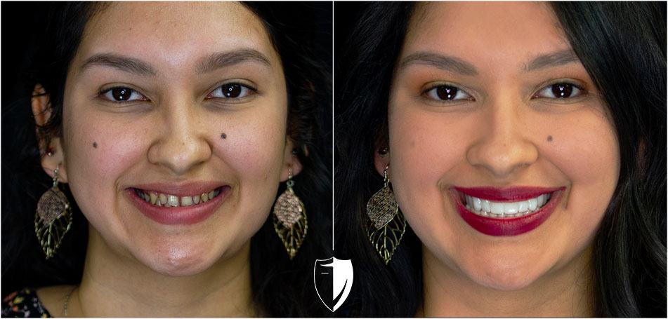 Perfect Smile Makeover without Invisalign or Cosmetic Dentist!