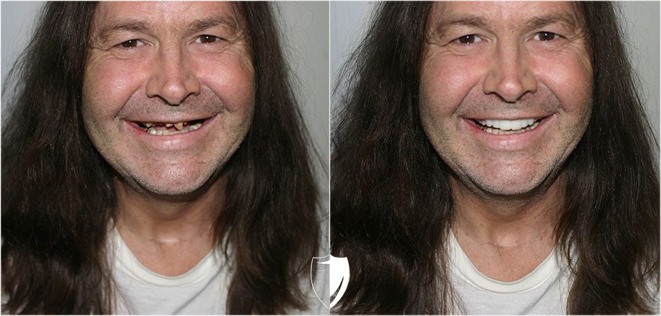 Dan-B dramatic-smile-transformation