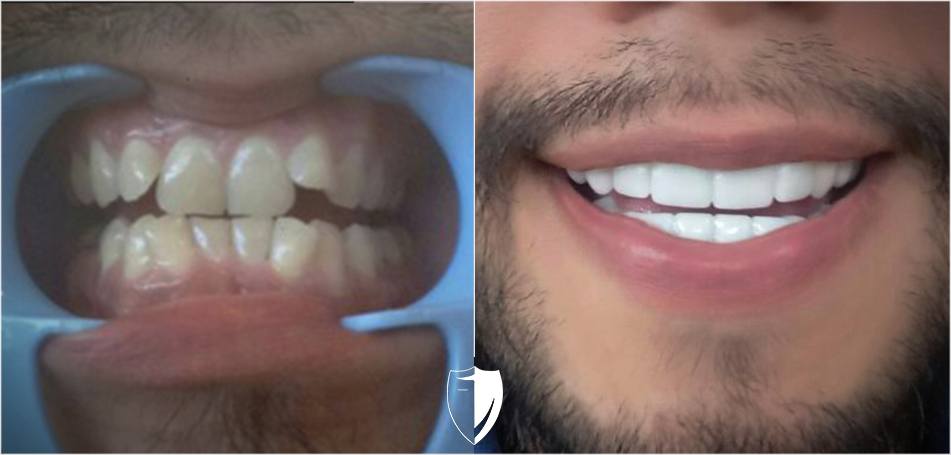 Kristen-C.jpg Bil Veneers made him smile, and Brighter Image Lab can do it for you
