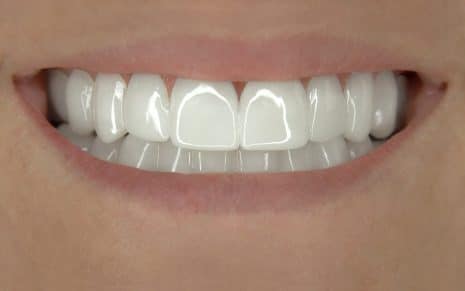 Real Client after IncrediBIL Veneers Real Client after IncrediBIL Veneers