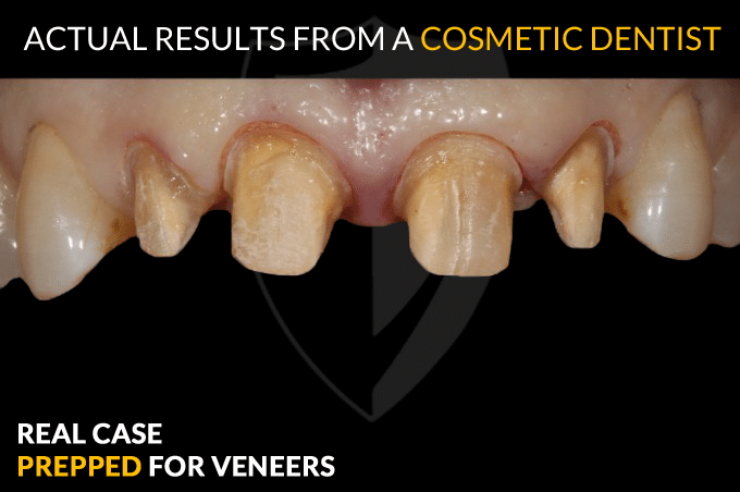 porcelain veneers porcelain veneers