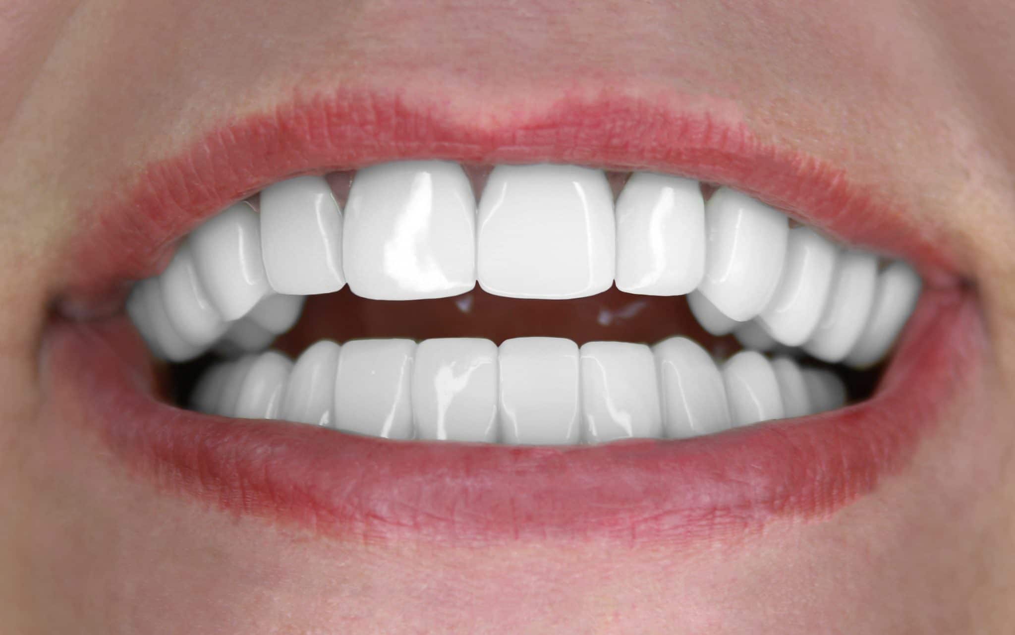 Tiffany gets Extreme Smile Makeover Free! Free Extreme Smile Makeover Winner!