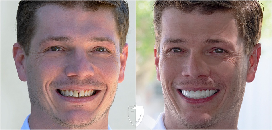 gap teeth fix