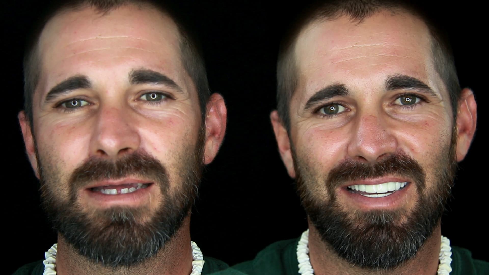 accident-smile-makeover