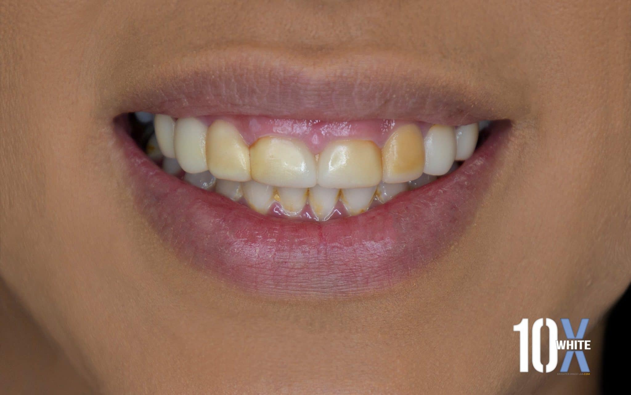 Extrinsic Staining Before Extrinsic Staining Before