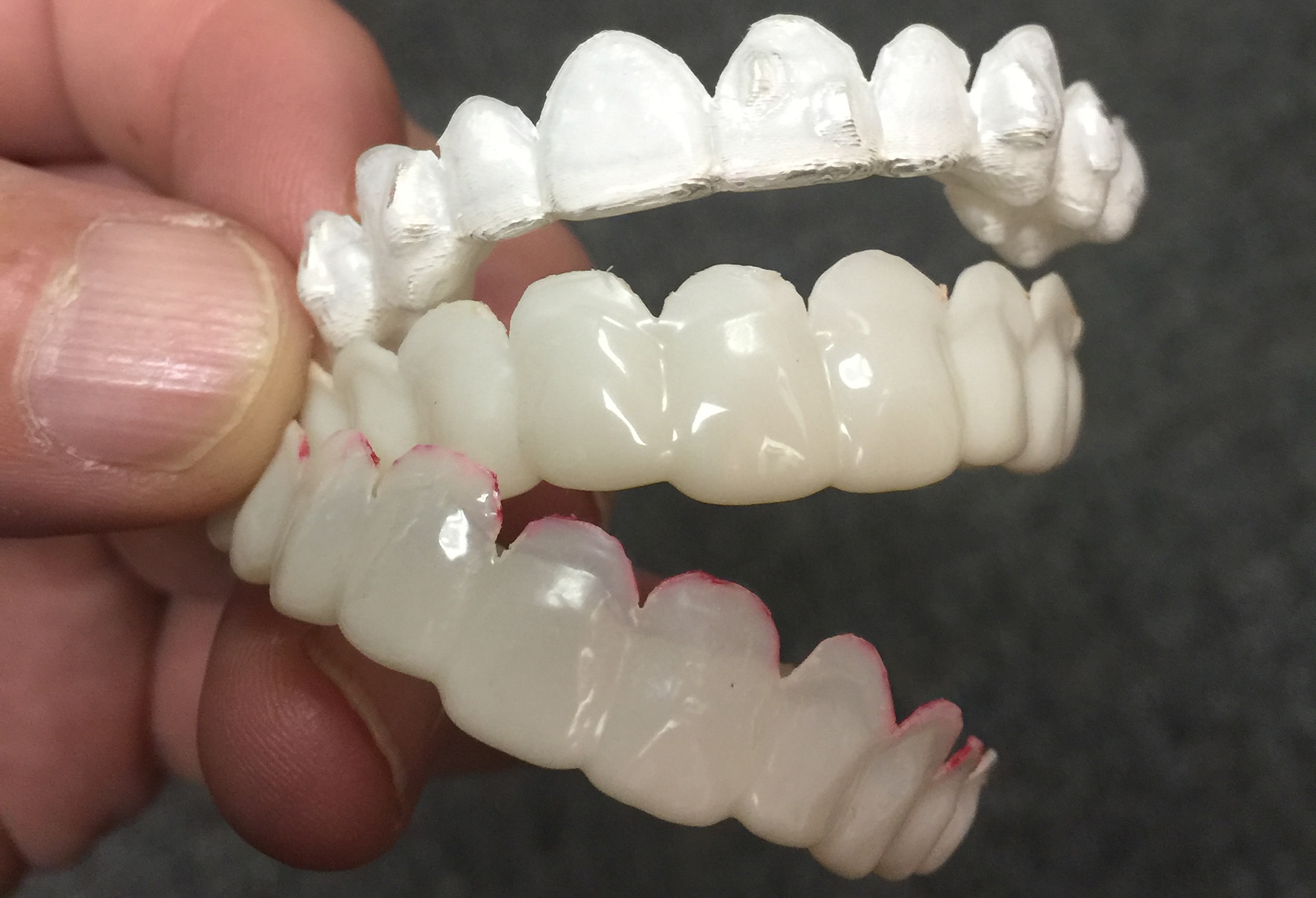 trusmile veneers trusmile veneers