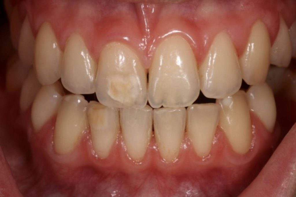6 Causes of Brown Spots on Teeth