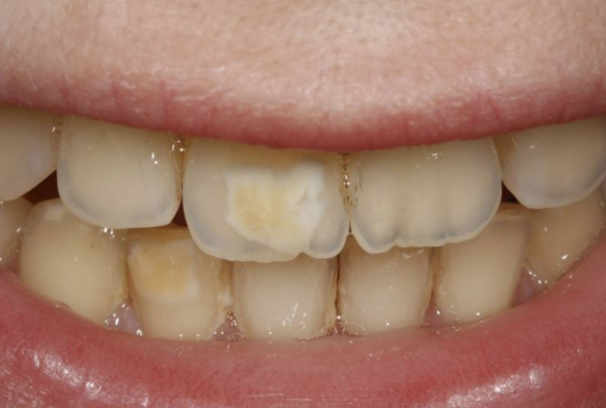 Zahnschäden - Ursachen, Beschwerden & Therapie | Gesundpedia.de
