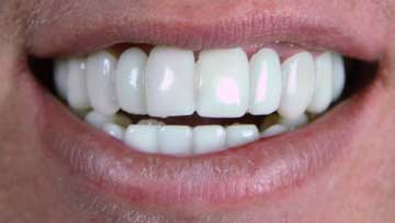 Brighter Image Lab veneers Brighter Image Lab veneers on our client Doug V.
