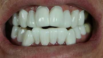 fake teeth veneers Fake teeth veneers on our client Doug V.