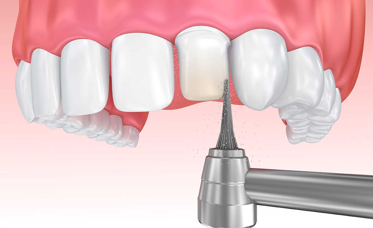 How to get a perfect smile with a dentist How to get a perfect smile with a dentist