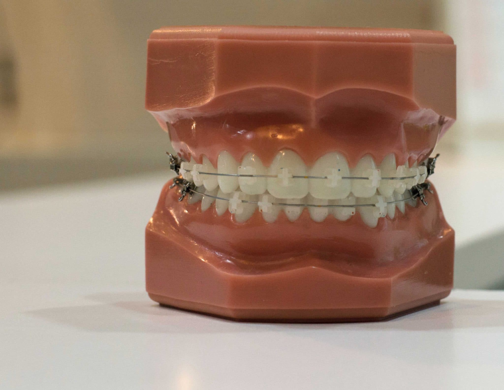 plastic-braces braces-sample