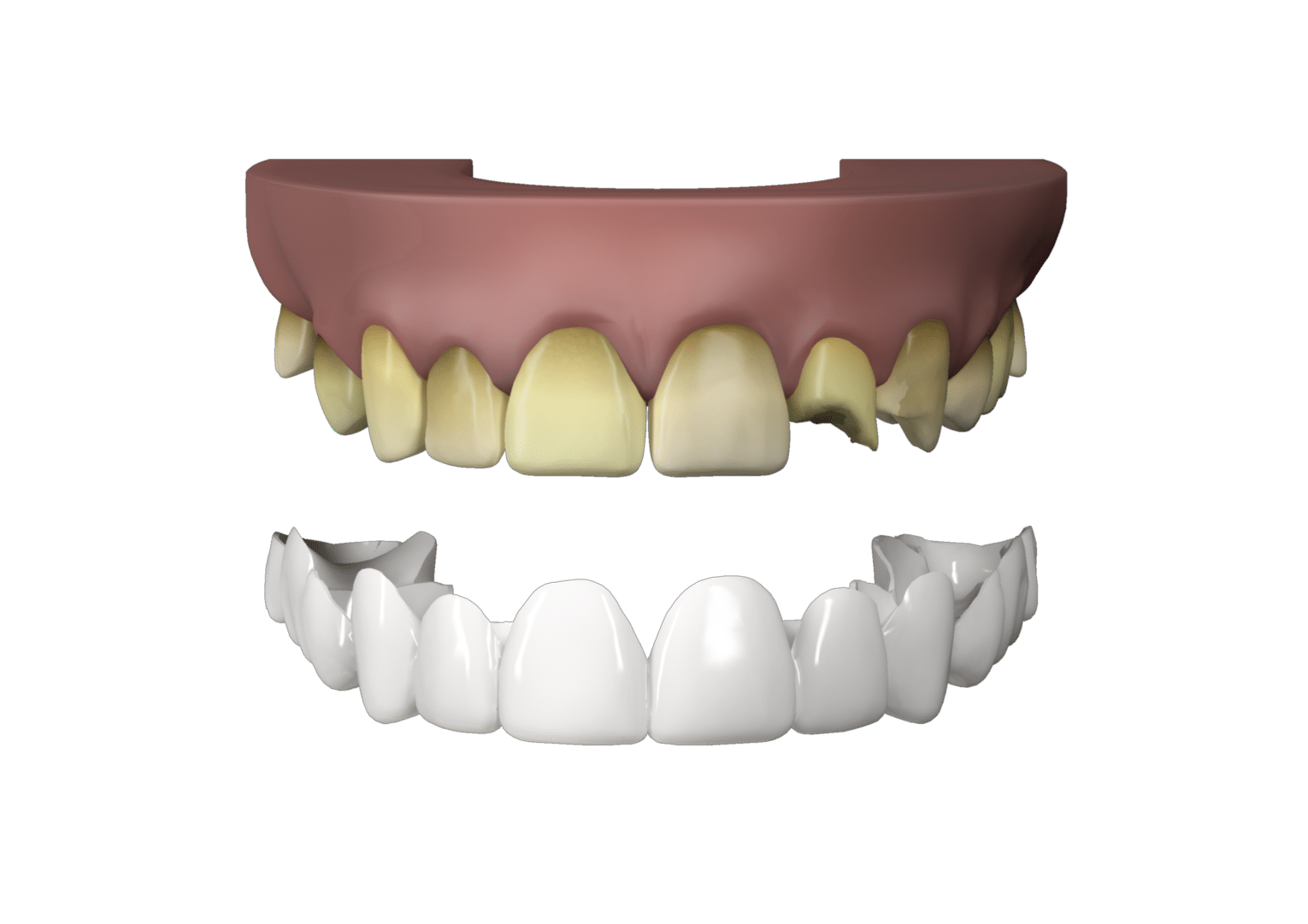porcelain veneers porcelain veneers