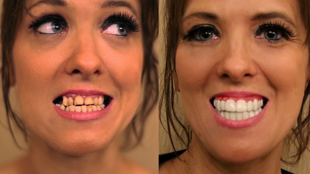 Removable Porcelain Veneers Smashed in a Fight
