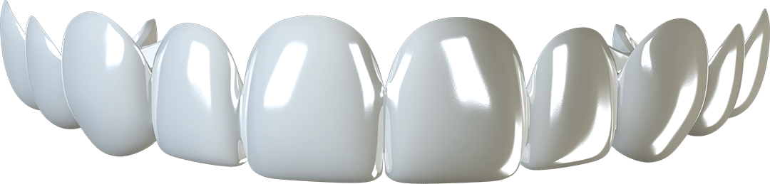 removable-veneers-compressed clip-on-veneers