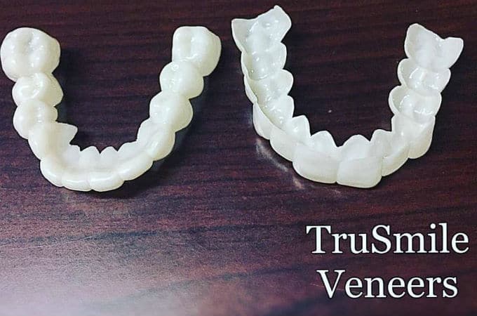 trusmile veneers trusmile veneers