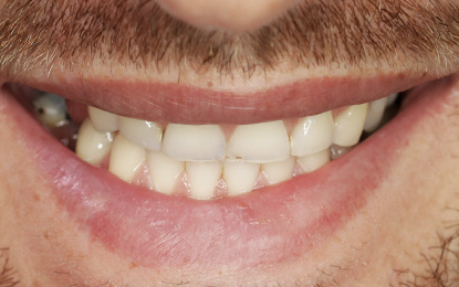 Brighter Image Lab Short Teeth Client Before
