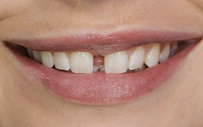 Brighter Image Lab Gapped Teeth Client Before