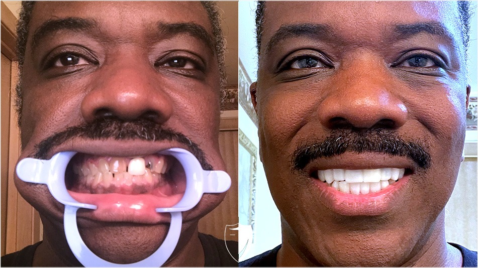 bilveneers-client-andre-s.jpg