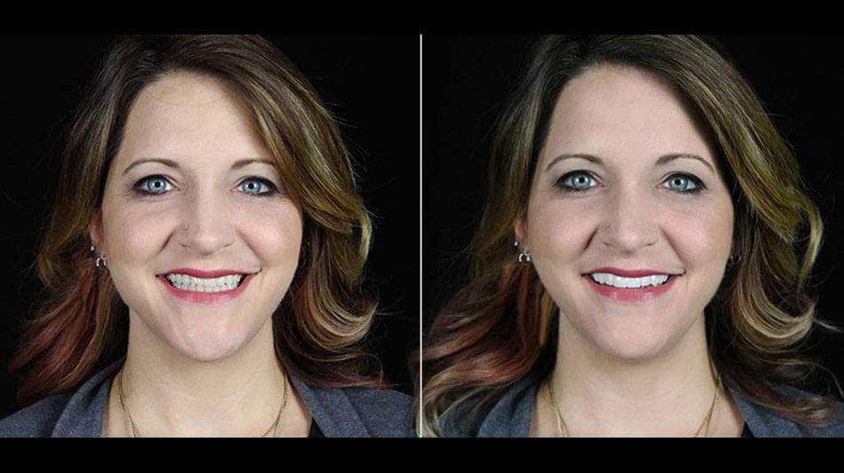 bilveneers-client-bridgette-1.jpg