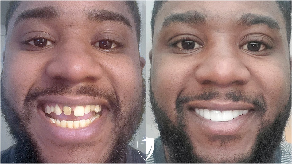 bilveneers-client-taurean-j.jpg