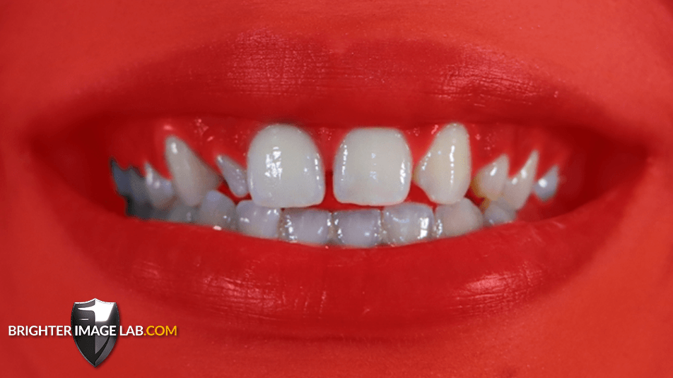 bilveneers-client-before-red-1-1.png