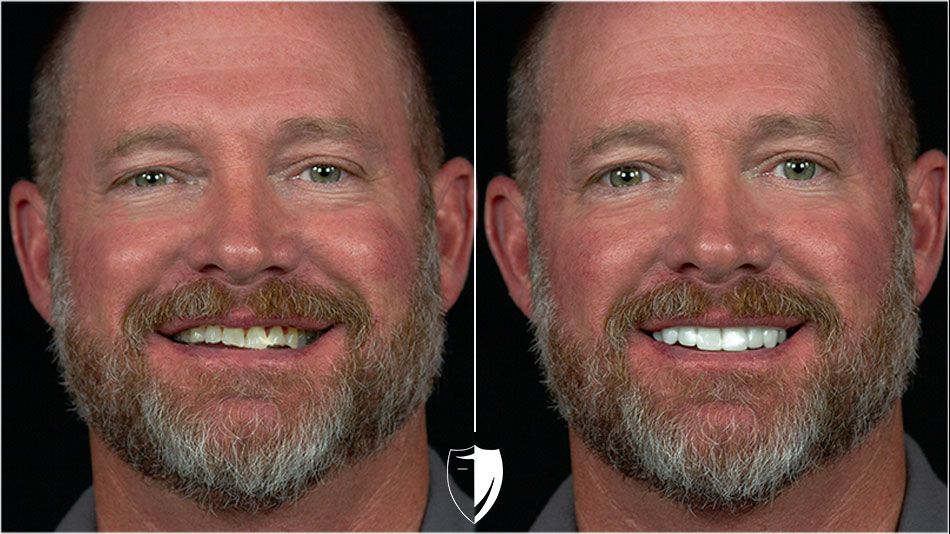 bilveneers-client-marty-s-1-1.jpg