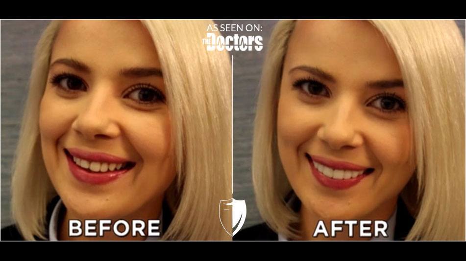 bilveneers-client-mika-1-1.jpg