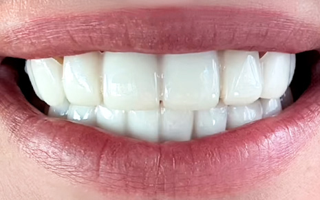 Lashes-After-Slider Lashes-After-Slider