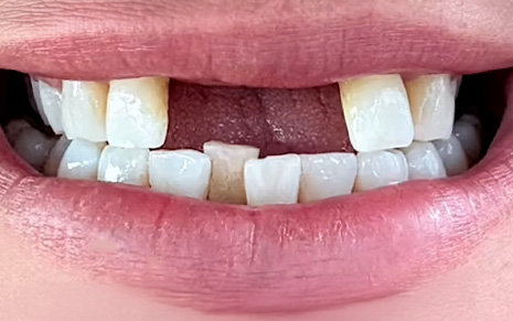 Lashes-Before-Slider Lashes-Before-Slider