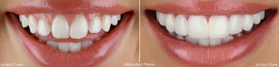 Before-AfterLG-2-1.jpg